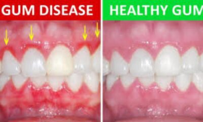 Understanding Gum Disease: What You Should Know