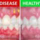 Understanding Gum Disease: What You Should Know