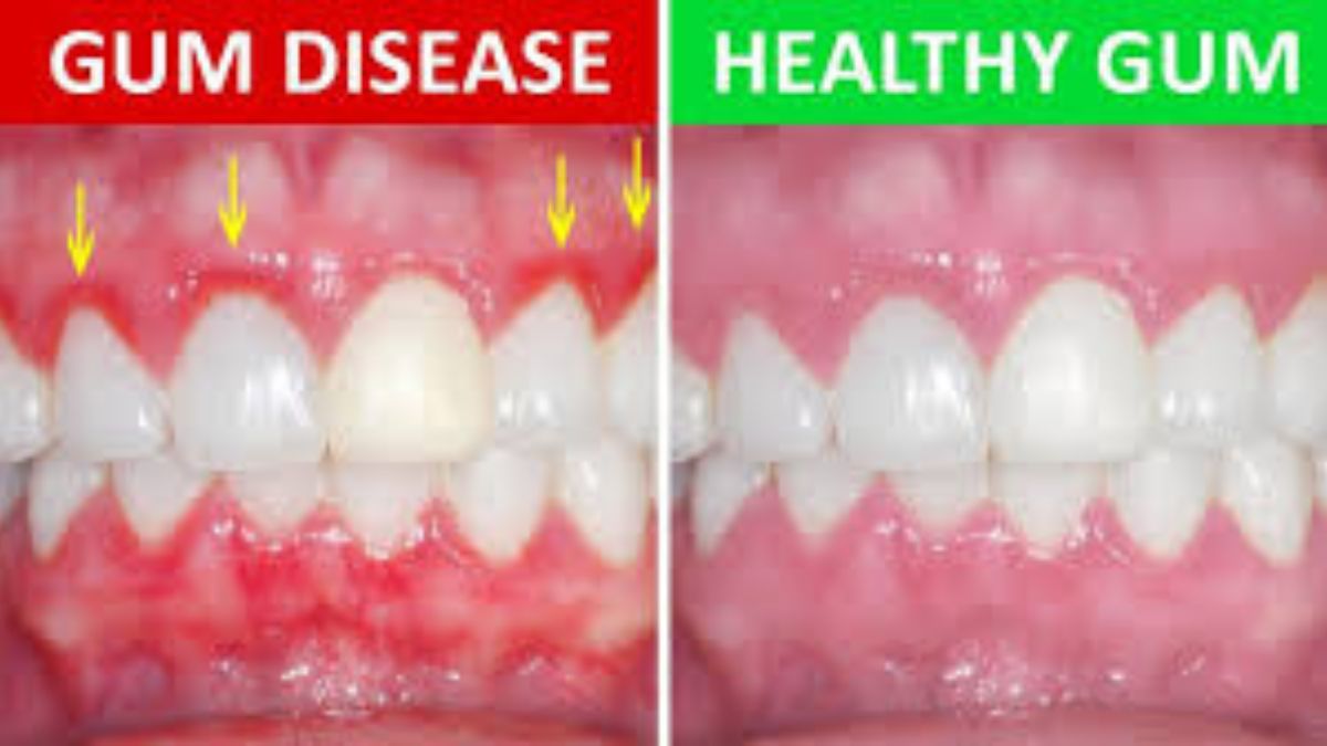 Understanding Gum Disease: What You Should Know