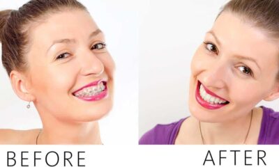 The Road to a Perfect Smile: Types and Benefits of Modern Braces