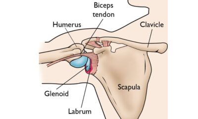 SLAP Tear