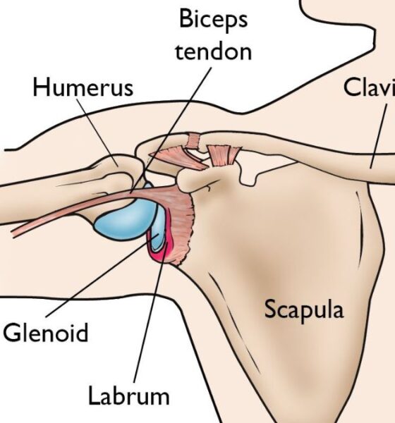 SLAP Tear