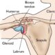 SLAP Tear