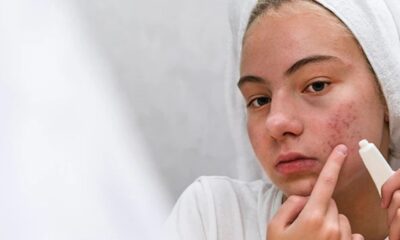 8 Everyday Habits That Could Be Making Your Acne Worse