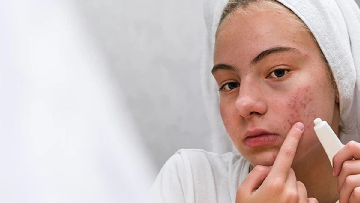 8 Everyday Habits That Could Be Making Your Acne Worse